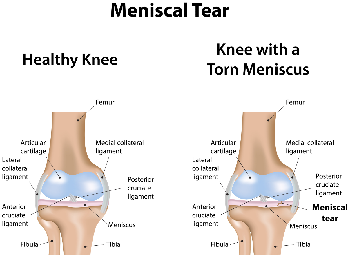 Meniscus Tear